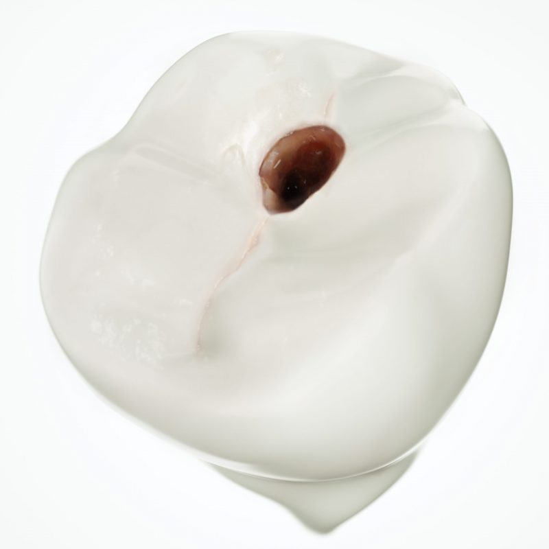 Mehr über den Artikel erfahren Degenerativer medialer Zahnschwund